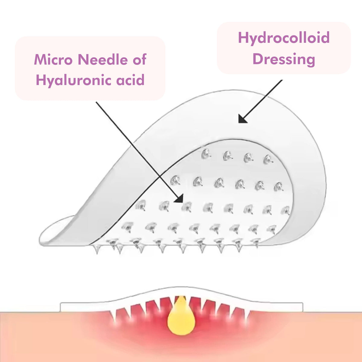 Microneedle pimple patch featuring visible microneedles and hydrocolloid dressing for targeted skin treatment.